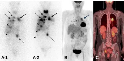 Figure  2.  After  3  months  after  first  131 I-MIBG  therapy  at  a  dose  of  7.4  GBq,  pre-therapy  131 I-MIBG  scintigraphy  was  done