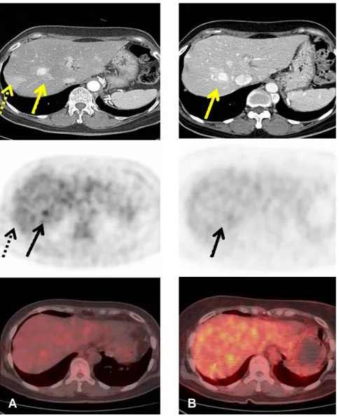 Figure  3.  Pre-therapy  18 F-FDG  PET/CT  shows  two  enhancing  lesions  in  transaxial  view