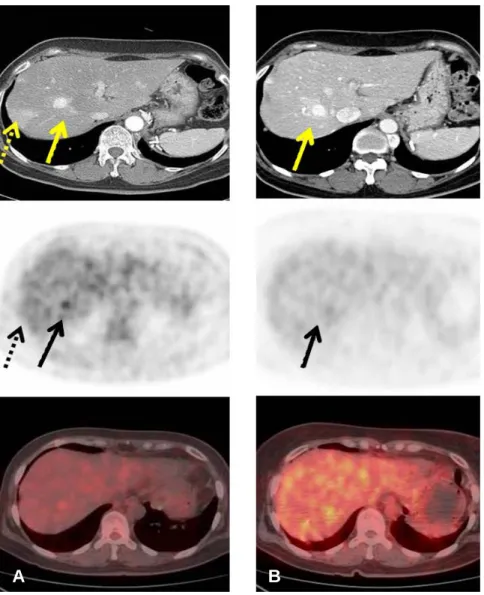 Figure  3.  Pre-therapy  18 F-FDG  PET/CT  shows  two  enhancing  lesions  in  transaxial  view