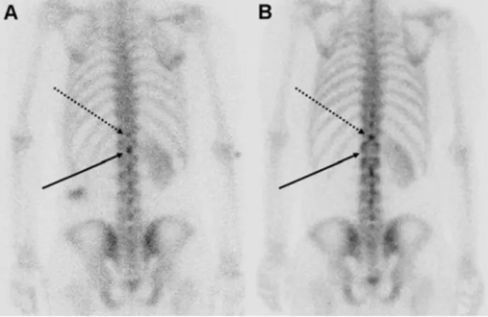 Figure  2.  The  hot  lesion  in  the  first  lumbar  spine  of  initial  99m Tc-HDP  bone  scintigraphy  (A,  black  arrow)  is  changed  to  cold  lesion  in  follow  up  99m Tc-HDP  bone  scintigraphy  after  12  months  of  left 