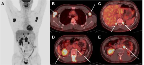 Figure  4.  The  maximum  intensity  projection  (MIP)  image  of  18 F-FDG  PET/CT  (A)  after  12  months  of  left  total  nephrectomy  shows  multiple  hypermetabolic  lesions