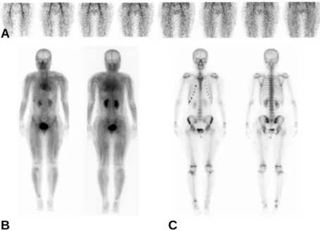 Figure  4.  99m Tc-HDP  three-phase  bone  scan  was  underwent  3  months  after  steroid 