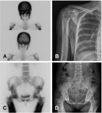 Figure  2.  Anterior  and  posterior  images  of  99m Tc-MDP  bone  scan 