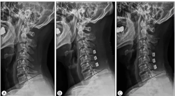 Fig. 1. Cervical lordosis, defined as the  angle between C2 and C7 inferior end  plates