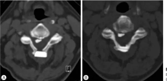 Fig. 2. Spacer resorption was defined that the  shape of spacer is smaller or changed on CT  im-ages