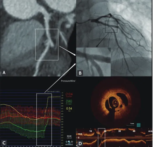 Figure 1. (A) Multi-detector com- com-puted tomography shows a minimal  coronary stenosis in the left  anteri-or descending artery (LAD)