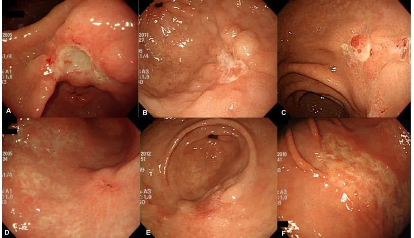 Fig 1. Endoscopic appearance of stages of ulcer in EGC. (A) A1 stage (B) A2 stage (C) H1 stage (D) H2 stage (E) S1 stage (F) S2 stage.