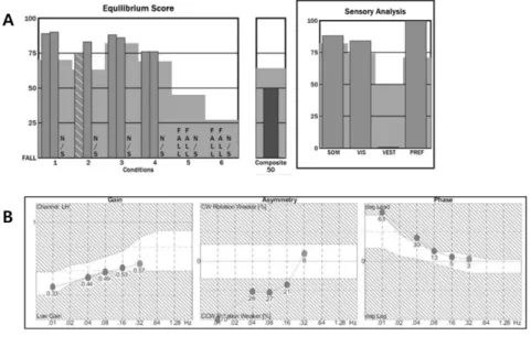 Figure 3. (A) Computerized dynamic posturography (CDP) revealed  vesti-bular dysfunction in condition 5 and 6