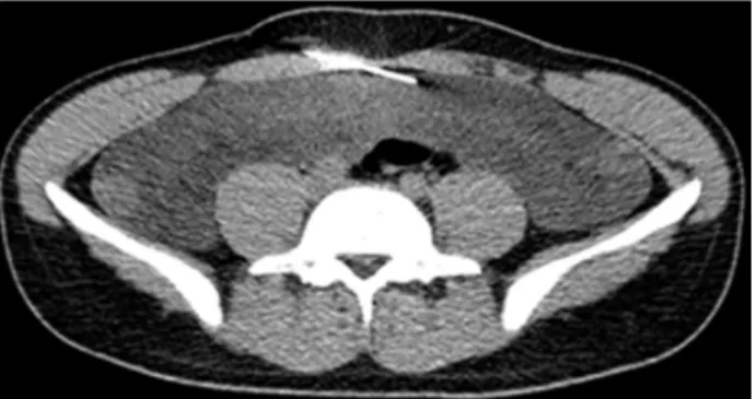 Fig. 2. Computed tomography scan-guided transabdominal biopsy of mesentery was performed.