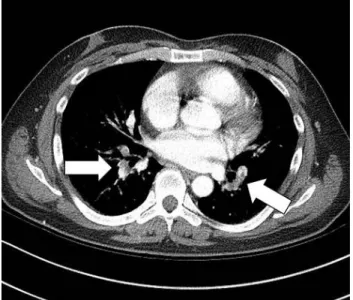 Figure 2. Computed tomography of the chest shows low-density  filling defects in both pulmonary arteries (arrows).