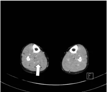 Figure 3. Computed tomography angiography of the low ex- ex-tremity shows low-density filling defects in the right calf vein  (arrow)