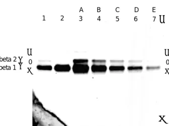 Fig. 5. Electrophoresis with transferrin IF-SS method shows transterrin in otorrhea specimen from patient with recurrent meningitis