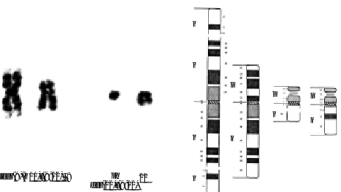 Fig. 3. RT-PCR for detecting major BCR-ABL gene rearrange- rearrange-ment. The band of 363-bp indicates the segments of BCR-ABL fusion transcripts