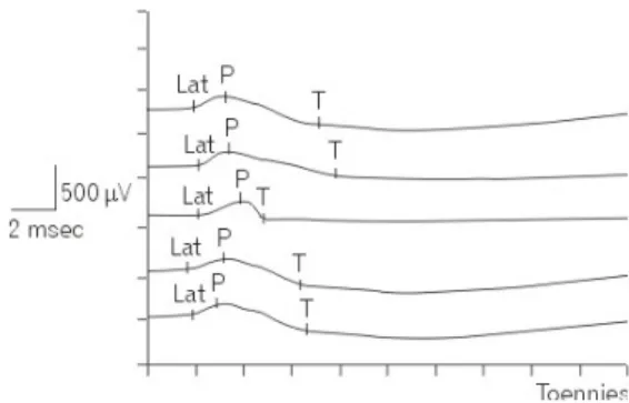 Fig.  1.  Measurement  of  compound  muscle  action  poten- poten-tials  of  sternocleidomasoid  tendon  reflexes.