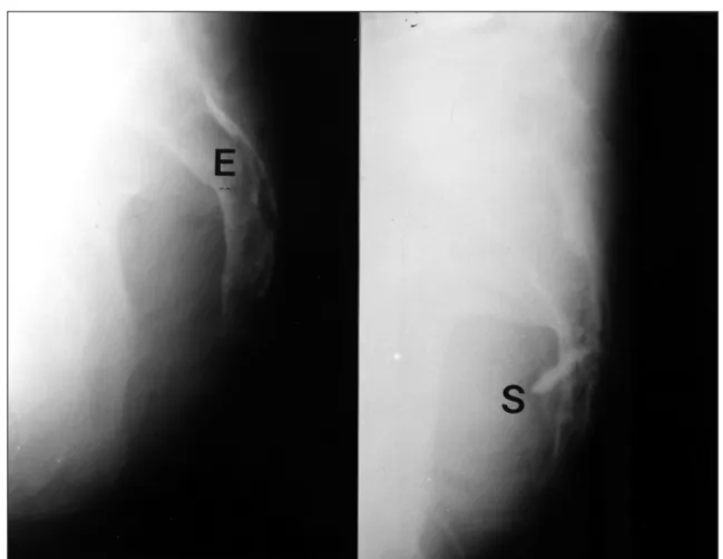Fig. 2. The lateral sacral view of correctly located caudal epidural injection of contrast medium revealing free flow through  sacral canal(Left, E), and of malpositioned needle in soft tissue dorsal to canal(Right, S)