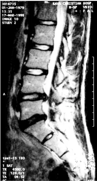 Fig. 3. L-spine sagittal T2 weighted image of 53-years old ma- ma-le(Case 11) shows disc extrusion on right side of L4/5  int-erspace with marked compression of thecal sac