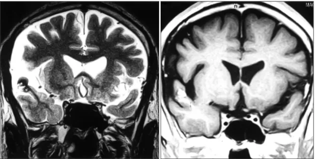 Fig. 1. T2 &amp; T1-weighted coronal MRI of 40-year old male presenting complex partial seizures show a cavernous malformation in  the right superior temporal gyrus