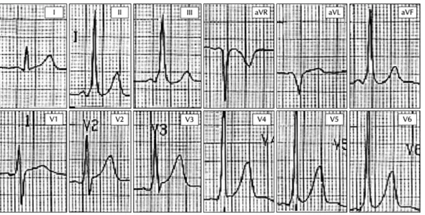 Fig. 3. Surface electrogram in 50-year old male patient with left lateral accessory pathway and 0.16 second of mean QRS duration