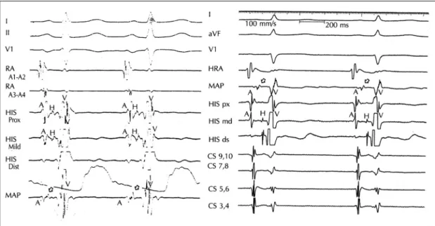 Fig. 1. Schematic illustration of the target sites for ra- ra-diofrequency energy application using the anatomic  approach
