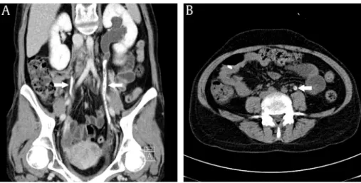 Figure 1. Abdominal CT. (A) Curved multiplanar reconstruction imaging shows bilateral ureter calciﬁcation (arrows) with hydronephrosis of the left kidney