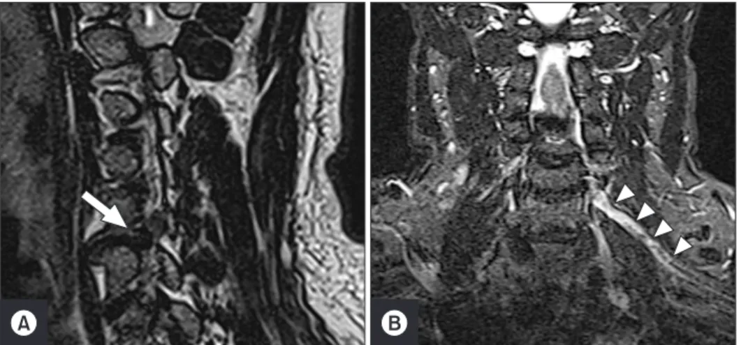 Fig. 2. Images of case 2. (A) C4-5  intervertebral disc herniation  (arrow) compressing the right C5  root