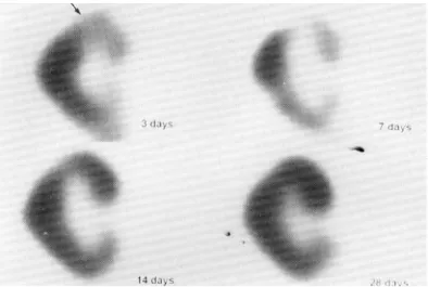 Fig. 2. Coronal tomographs of sequential Tc-99m MAG3 renal SPECT studies in a 35 years old woman with acute tubular necrosis of the allograft kidney