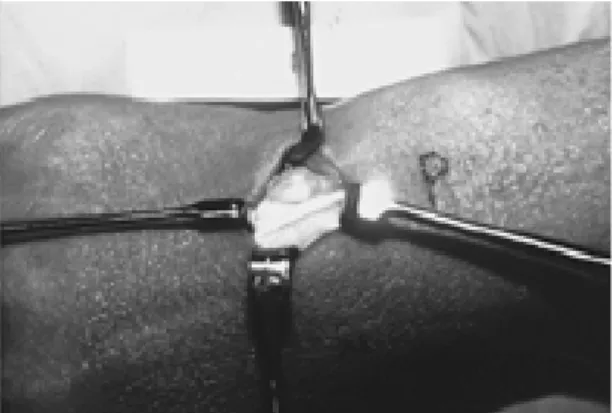 Fig. 3. Pathologic examination shows cystic lumen with containing thick clear mucoid fluid.
