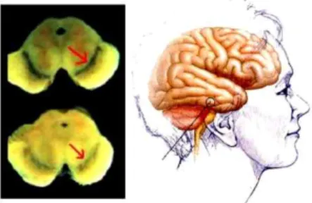 그림 1. 뇌의 흑색질(substantia nigra) 위치(정상인: 위, 파킨슨씨병 환자: 아래) 2. 재료 및 방법