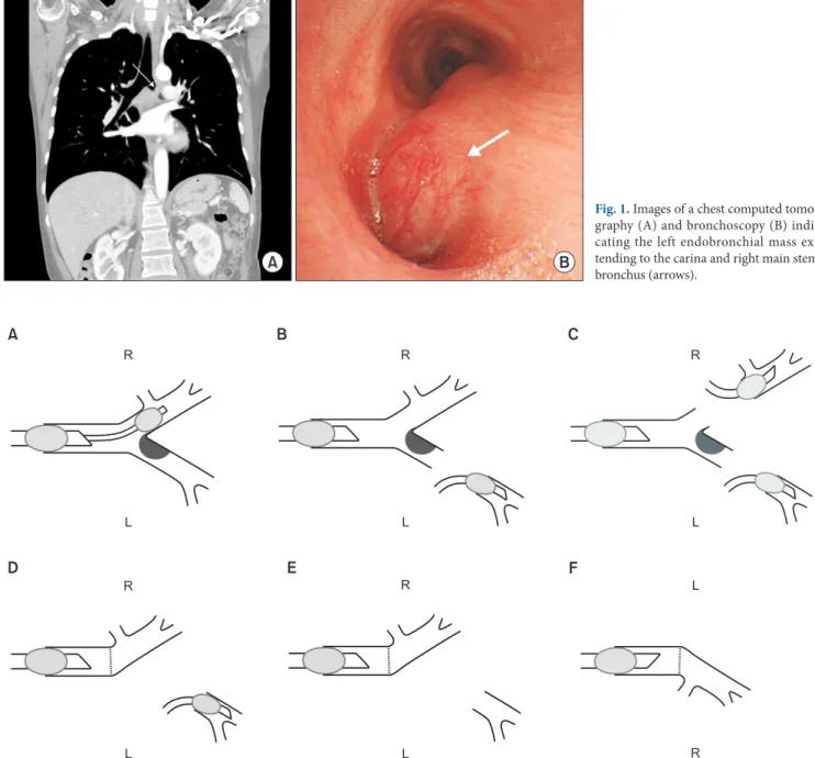 Fig. 1. Images of a chest computed tomo- tomo-graphy (A) and bronchoscopy (B)  indi-cating the left endobronchial mass  ex-tending to the carina and right main stem  bronchus (arrows)