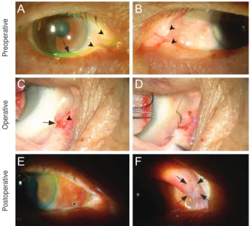 Fig. 1. Initial ocular examination of the (A) right (B) left eyes  in a 75-year-old male patient
