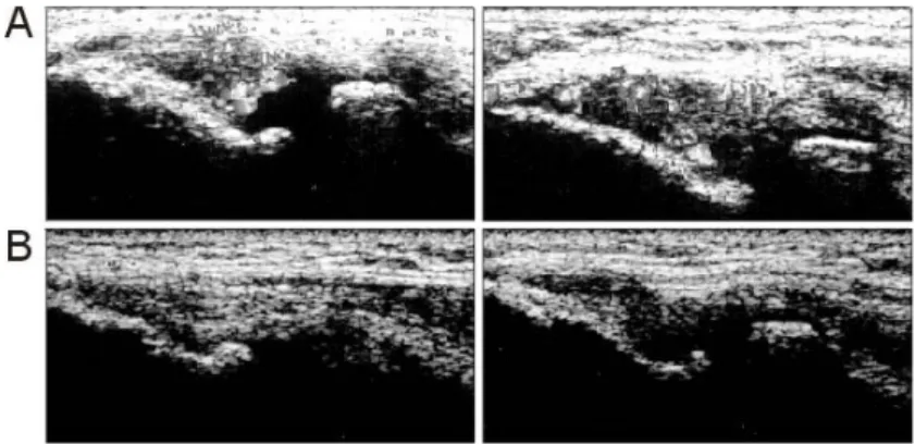 Fig.  2.  Longitudinal  (upper)  and  transverse  (lower)  ultrasonographic  findings  in  tardy  ulnar  nerve  palsy