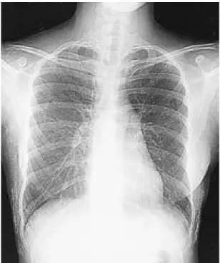 Fig. 1. Anteroposterior view of the chest shows diffuse subcutaneous calcification of the thoracic wall