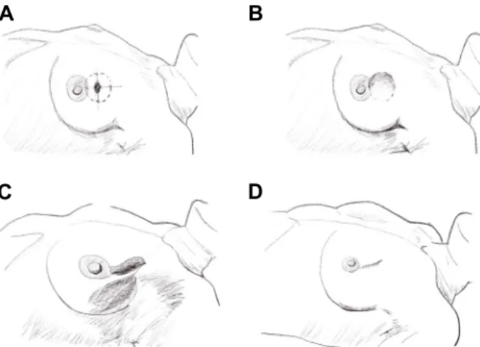 Fig.  1.  The  necessity  of  oncoplastic  technique  in  breast  cancer  surgery.  A:  Minimal  1.5  cm  resection  margin  from  tumor  border  is  required  to  get  the  safe  resection  margin,  B: 
