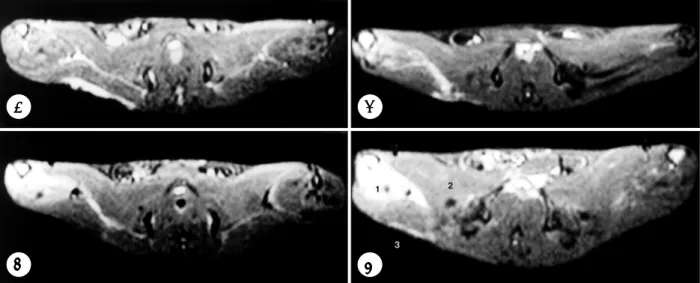 Fig. 1. STIR images of the hindlimb after transection of the right sciatic nerve. A：In sham operation, slight increase of signal  intensity is showing(arrow), although not significant