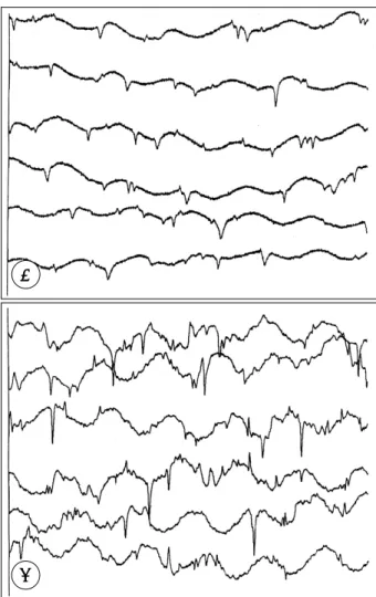 Fig. 2. EMG findings after transection of the right sciatic nerve.