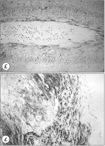 Table 3. Intensity and distribution of the vascular wall ma- ma-trix proteins in control and intracranial aneurysms  αSMA  Collagen type IV  No Classification 