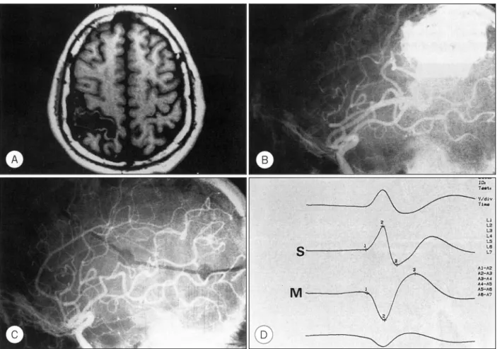 Fig. 3. Axial view of the MRI(A) and lateral view of the right internal carotid artery(ICA) angiogram(B) showing a large size of  AVM which located parietal lobe and involved motor strip of frontal lobe