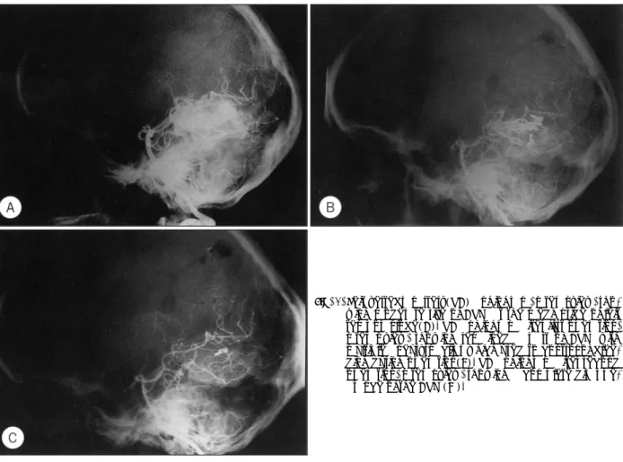 Fig. 4. Left vertebral artery(VA) angiogram, lateral view, sho- sho-wing moderate size of  AVM at the medial side of left temporal lobe(A)