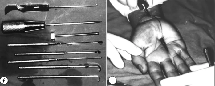 Fig. 1. A：Photograph showing the instrumentations used for the Brown technique of two-portal endoscopic carpal tunnel  release