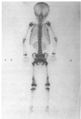 Fig. 2. AP  view  of  both  femur  in  5-yr-old  boy  (AML)  shows  diffuse  osteopenia  in  all   vi-sible  bone.