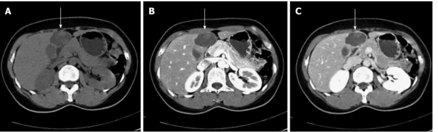 Figure 1  Abdominal dynamic computed tomography findings. A: Precontrast; B: Arterial phase; C: Delayed phase.
