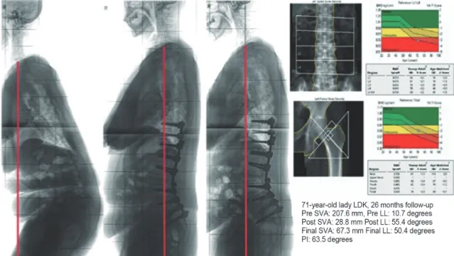 Fig. 1. Case example of 71 -year-old lady with osteoporosis who underwent posterior spinal fusion from T10 to ilium, ALIF at L4–5,  L5–S1, and partial pedicle subtraction at L3