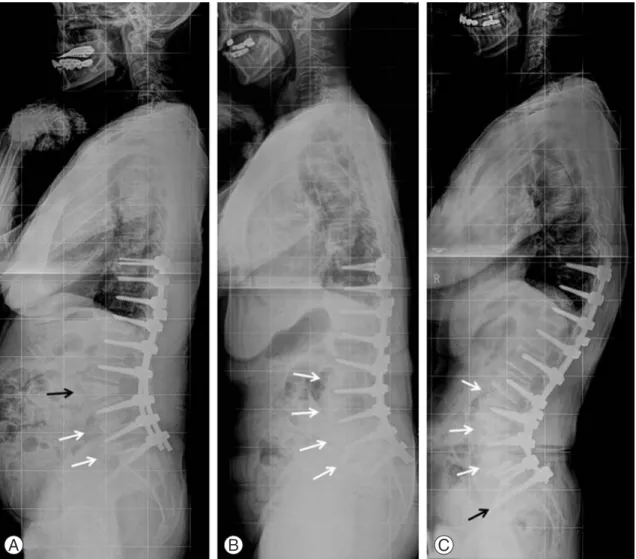 Fig. 1. Three whole spine lateral X-rays at the last follow-up representing the three different groups