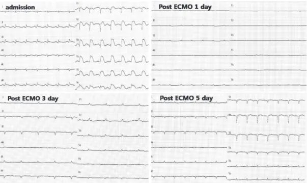 Fig. 1. Electrocardiogram at admission and ICU (admission: intraventricular conduction defect, V2~6 ST  elevation; Post ECMO 1 day: low voltage; Post ECMO 3 day: A-V block 1, low voltage; Post ECMO 5 day: 