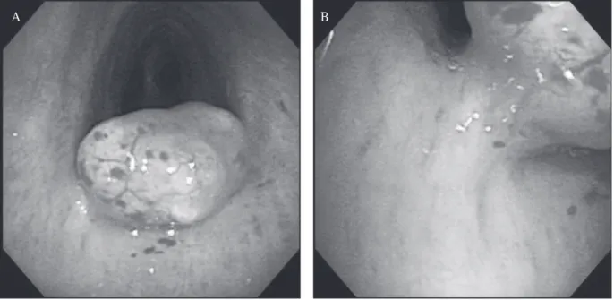 Fig. 3. An endoscopic mucosal resection (EMR) was done. (A) Epinephrine/normal saline solution (1:10000) fluid (2  cc) was injected into the stalk