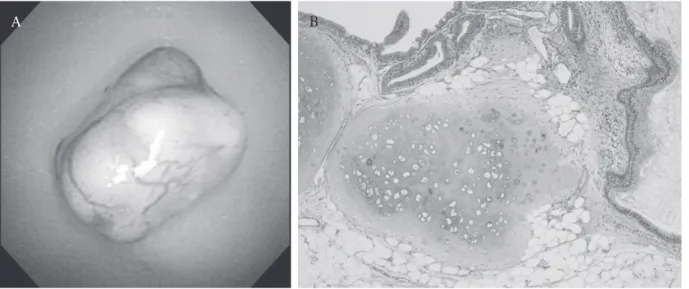 Fig. 5. After bronchoscopic resection, chest CT  scan was noramal in trachea.