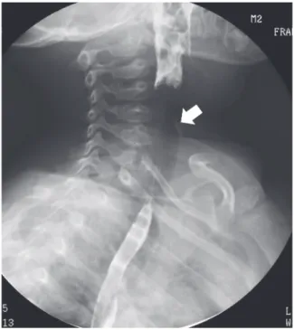 Fig. 3. Thyroid scan shows diffuse mildly decreased radioactivity of both thyroid glands.