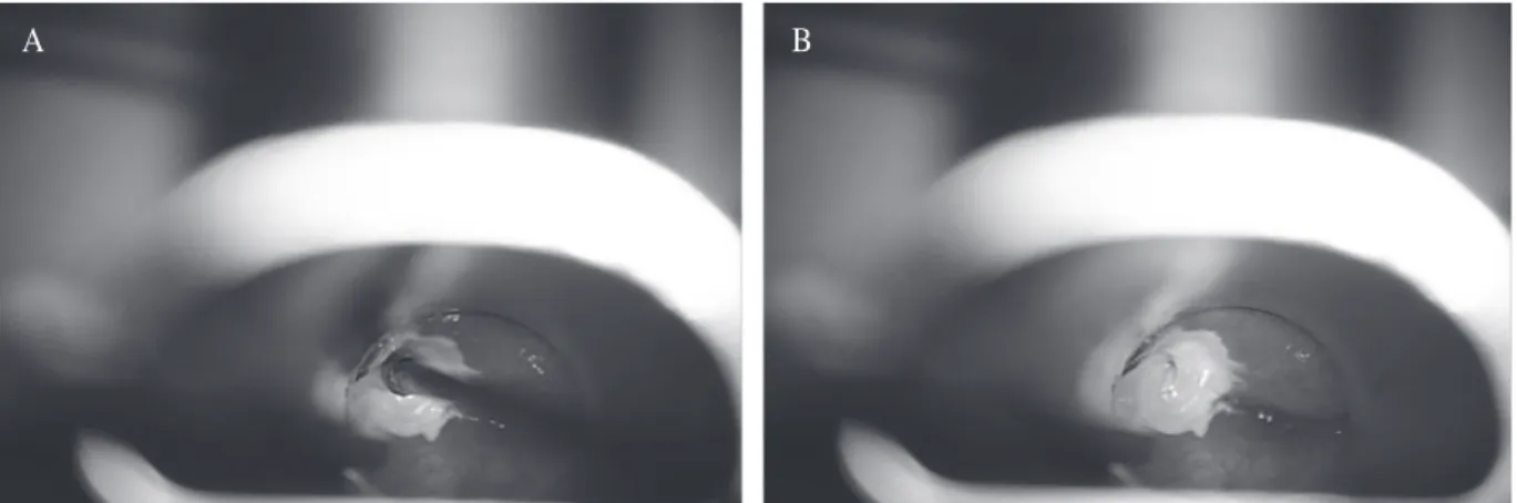 Fig. 5. Laryngoscopic finding of the chemocauterization. Internal opening of left piriform sinus fistula was cauterized  with 20% trichloroacetic acid (A) and right after cauterization (B).