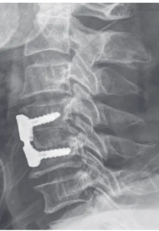 Fig. 3. Anterior cervical decompression and fusion  C4-5. Microscopic decompression, autogenous  bone graft and plate fixation was done.