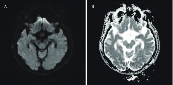 Fig. 2. Brain SPECT reveals decreased perfusion on the left temporal and frontal regions.
